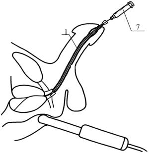 中国实用新型一种尿道外括约肌注射针